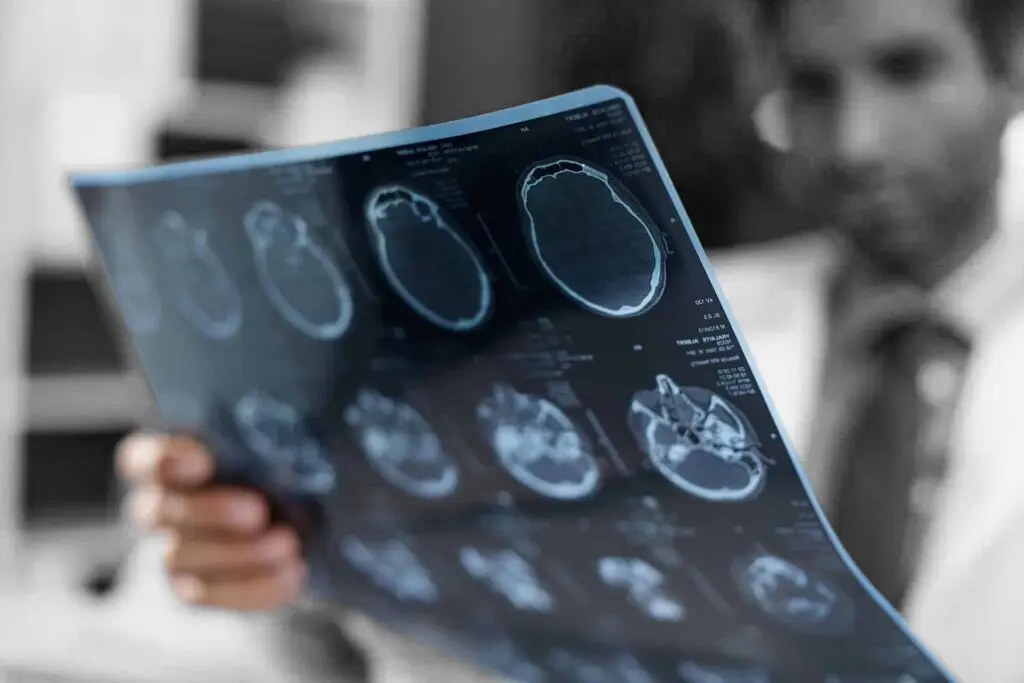 Magnetic resonance imaging of a brain