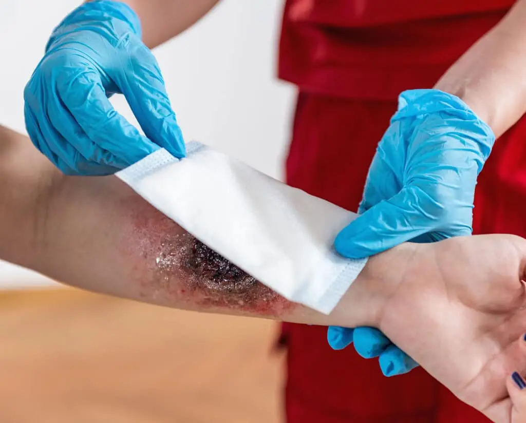 First aid training - burn injury