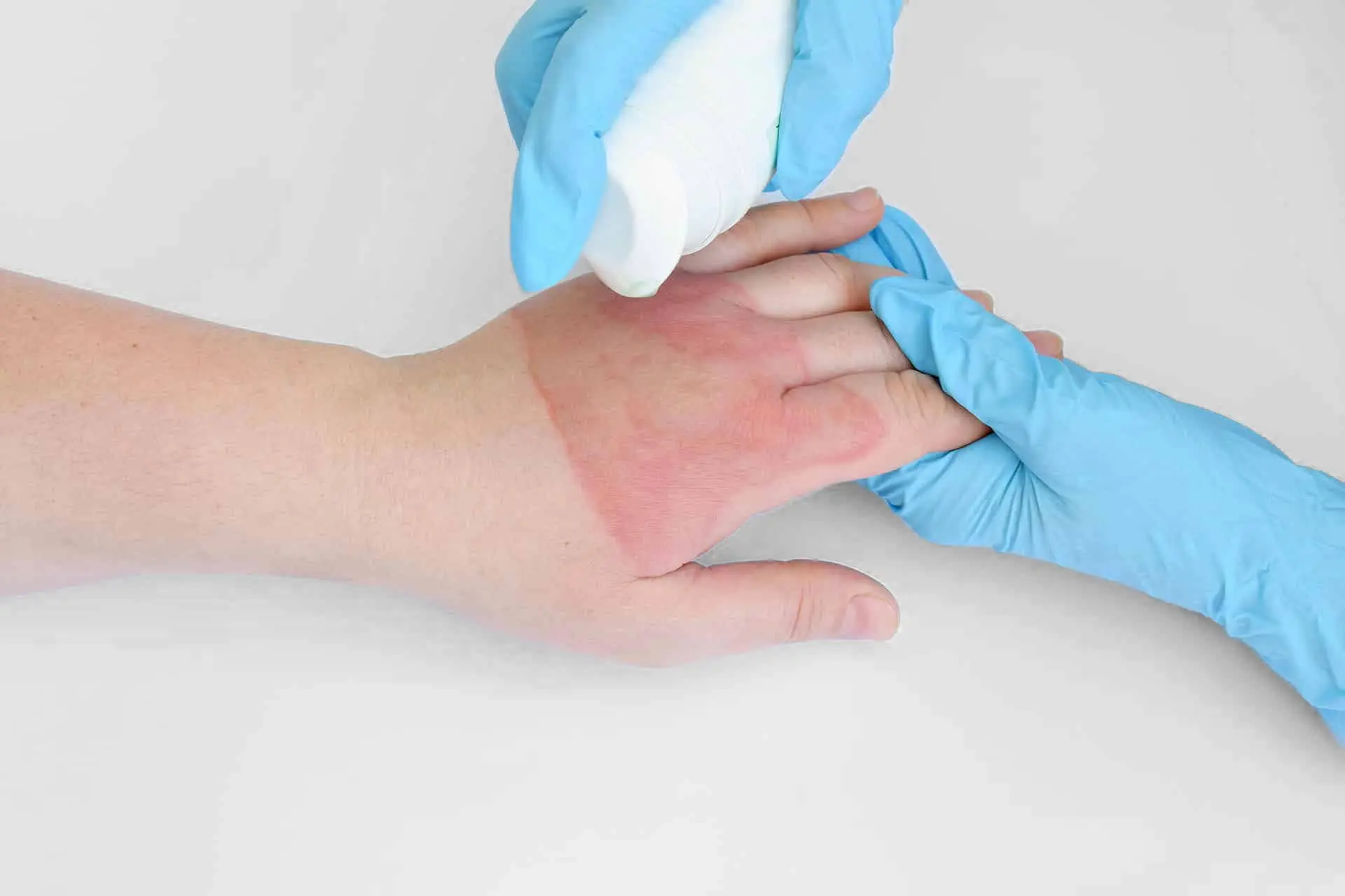 Doctor's hands holding female hand with second degree burns on white background.