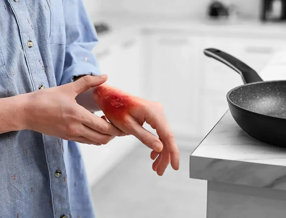 Woman with burn on her hand in kitchen