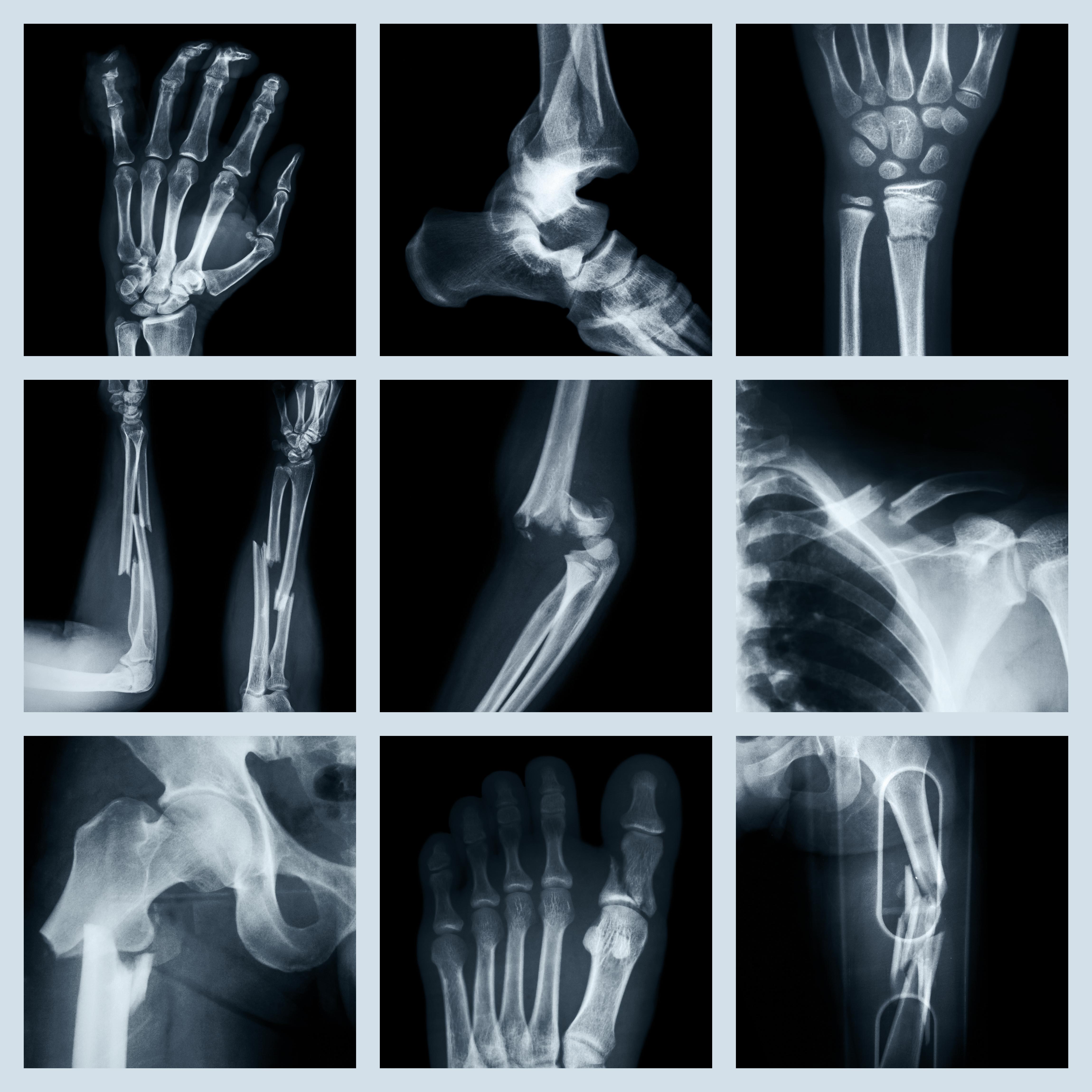 Broken bone X-ray